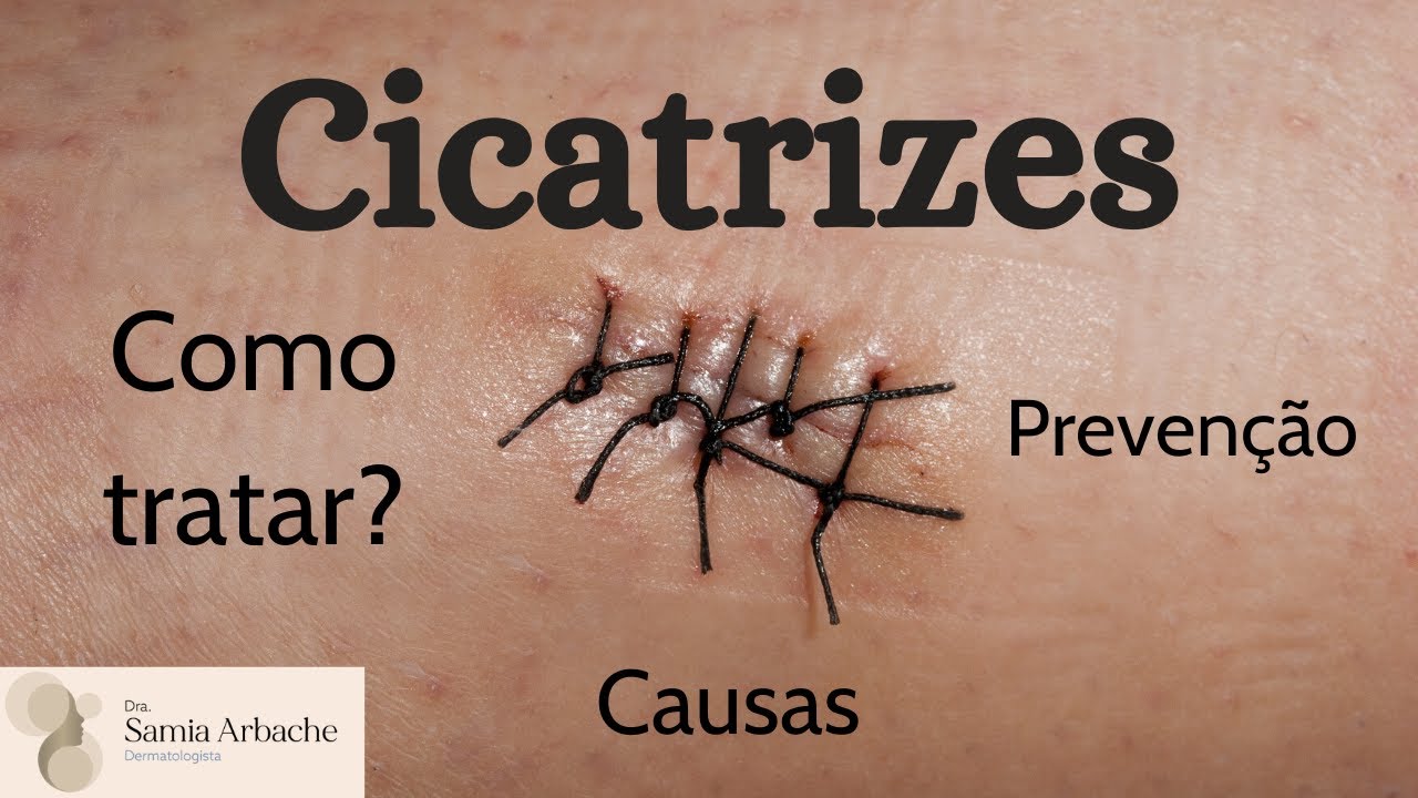 CICATRIZES: COMO EVITAR? QUAL O MELHOR TRATAMENTO?