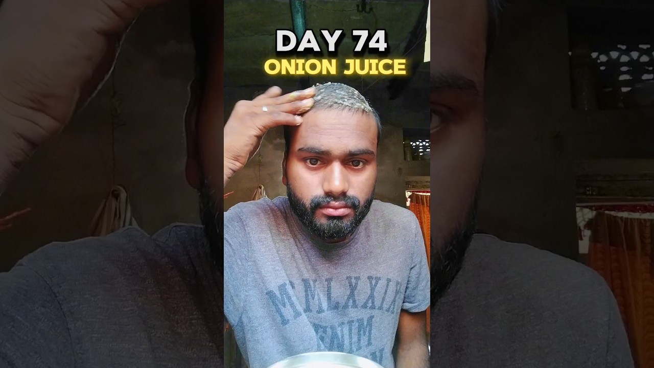 Day 74 use onion juice for hair regrowth #hairregrowthtreatment #hairfall