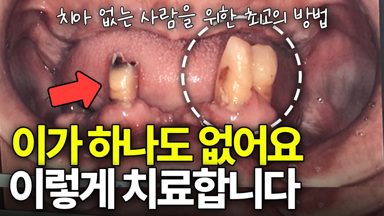 이가 하나도 없는 분들을 위한 최고의 방법