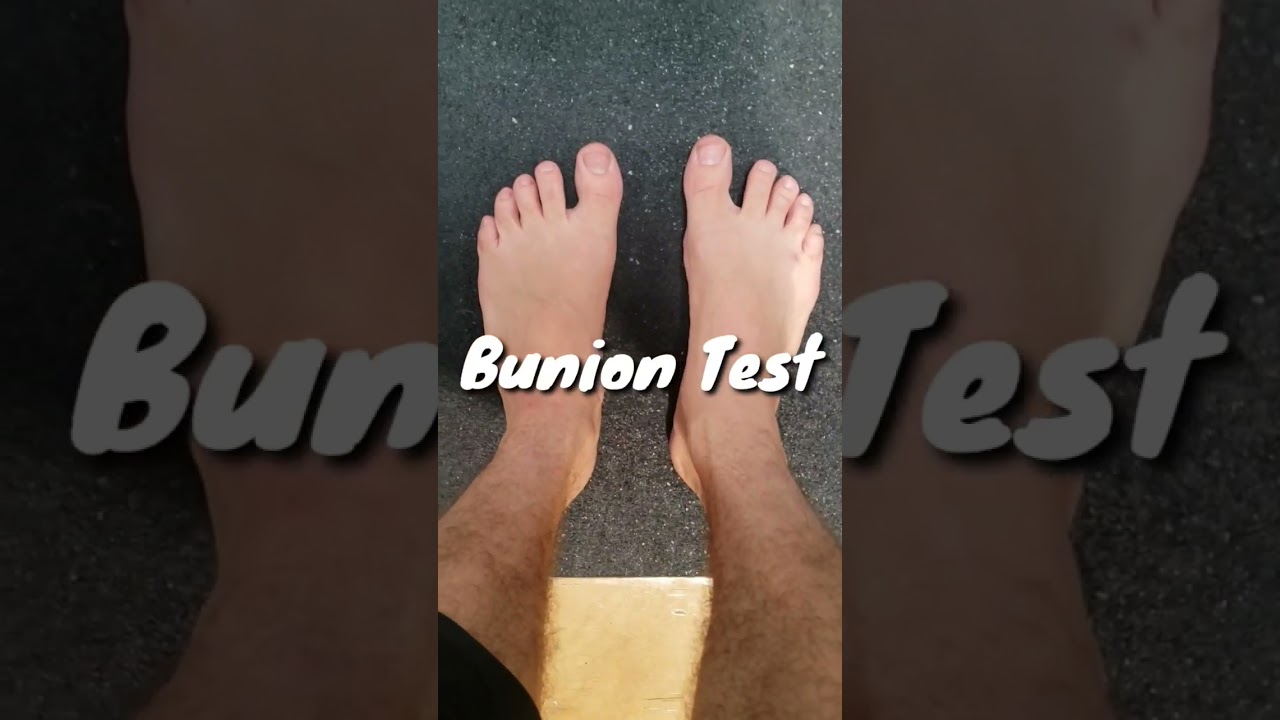 Do you have bunions??? Use this test to find out. #feet #bunions #barefoot #health #healthy #pt