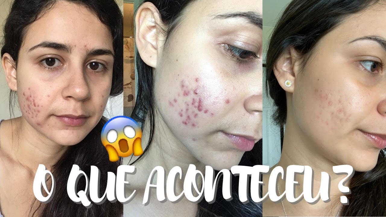 COMO EU TRATEI MINHA ACNE NO ROSTO | PRODUTOS QUE MUDARAM MINHA PELE COM ACNE #espinhas