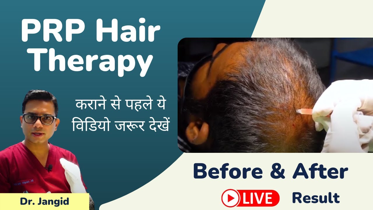 All About PRP Hair Therapy  | PRP Hair Treatment Live Results | Skinqure