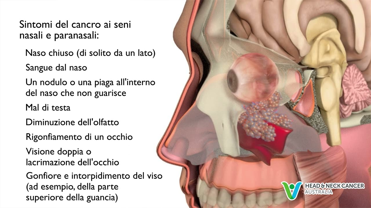 Italian - What is Sinus Cancer / Nasal Cancer? Signs & Symptoms. Head and Neck Cancer