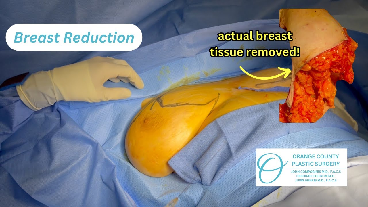Breast Reduction Surgery | Orange County Plastic Surgery