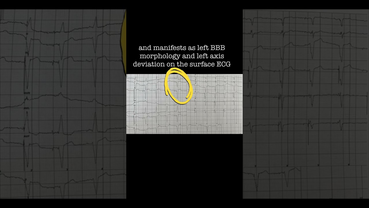 Right Bundle-Branch Block After Pacemaker Implantation
