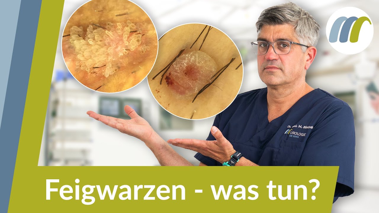 7 Dinge, die du über Genitalwarzen wissen musst (bevor es zu spät ist)