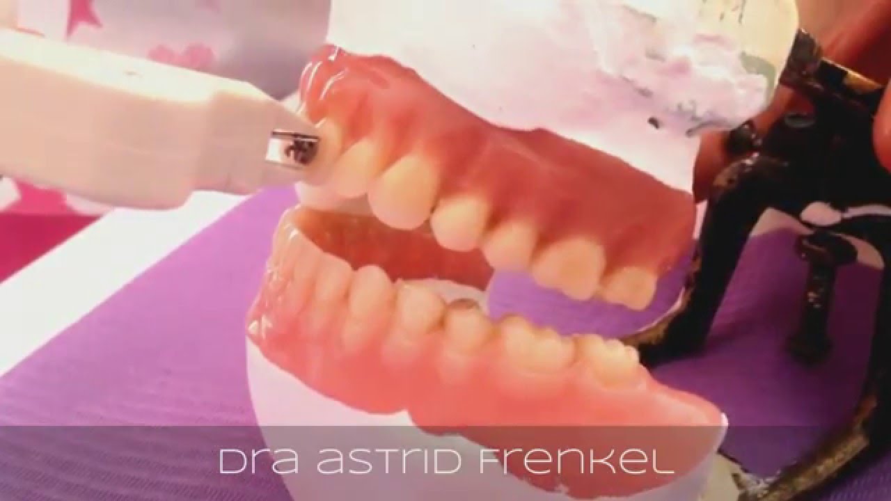 C&oacute;mo quitar brackets con la pinza 3M Unitek