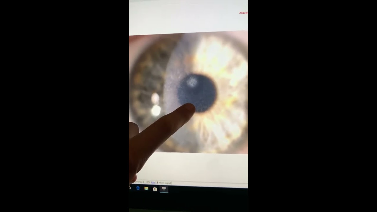 Reid-Bucklers Corneal Dystrophy, Kanellopoulos MD