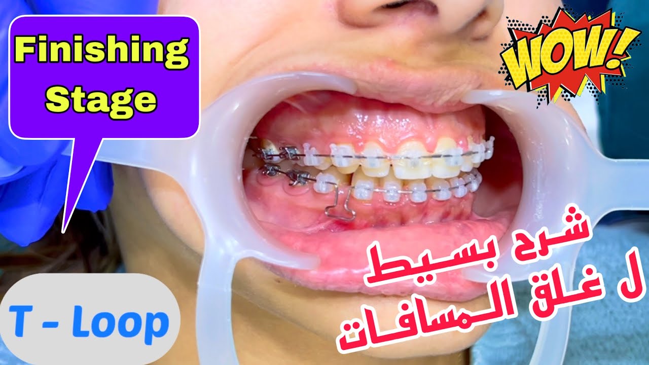 Orthodontic T-Loop | كيف يتم سد الفراغات في تقويم الاسنان