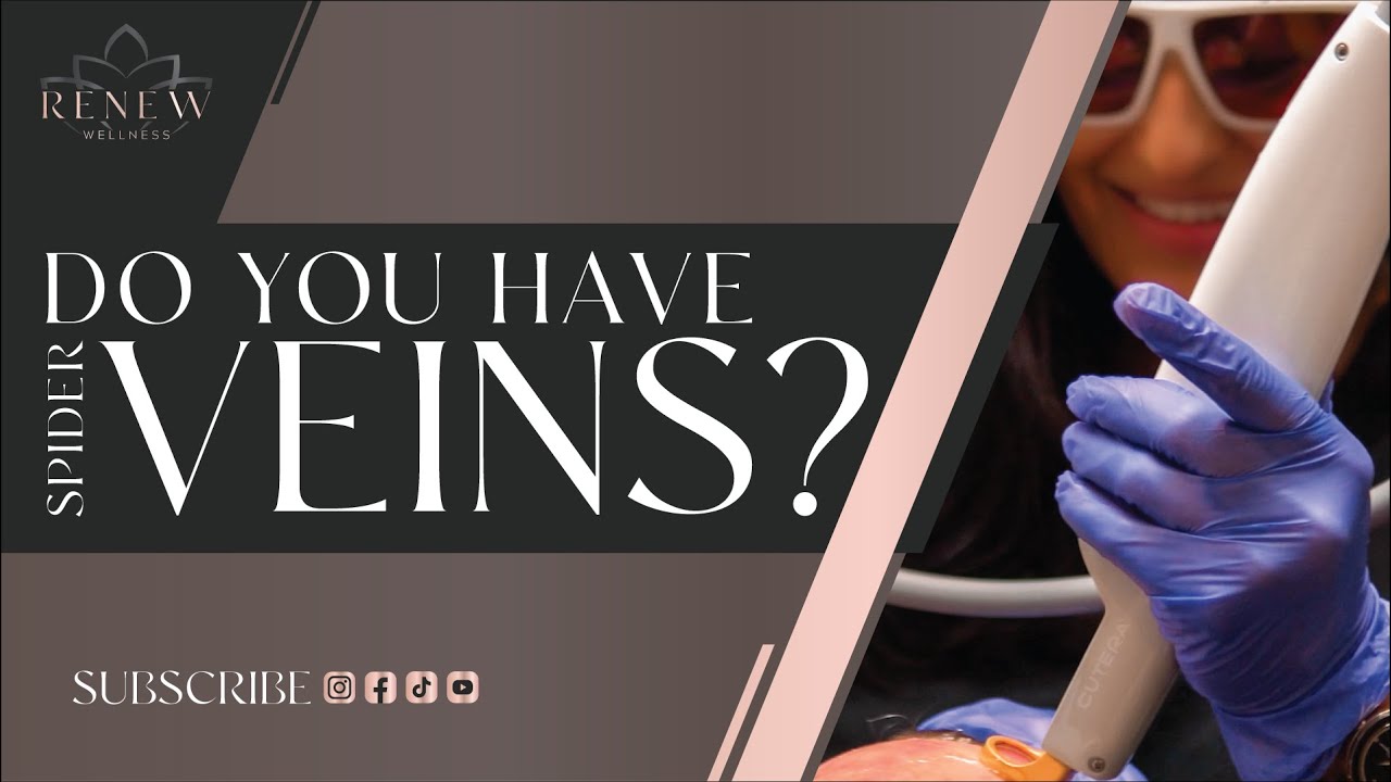 How To Instantly Get Rid Of Spider Veins!