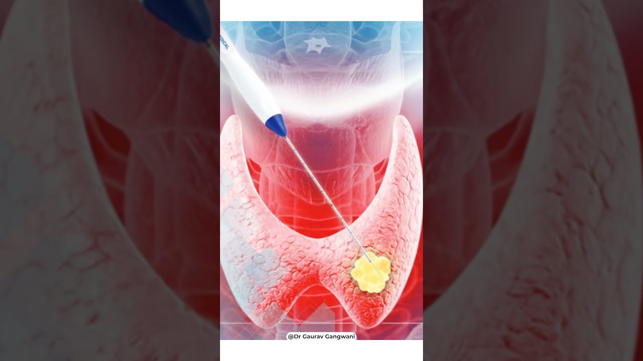 Thyroid Nodule Treatment without surgery | Dr. Gaurav Gangwani