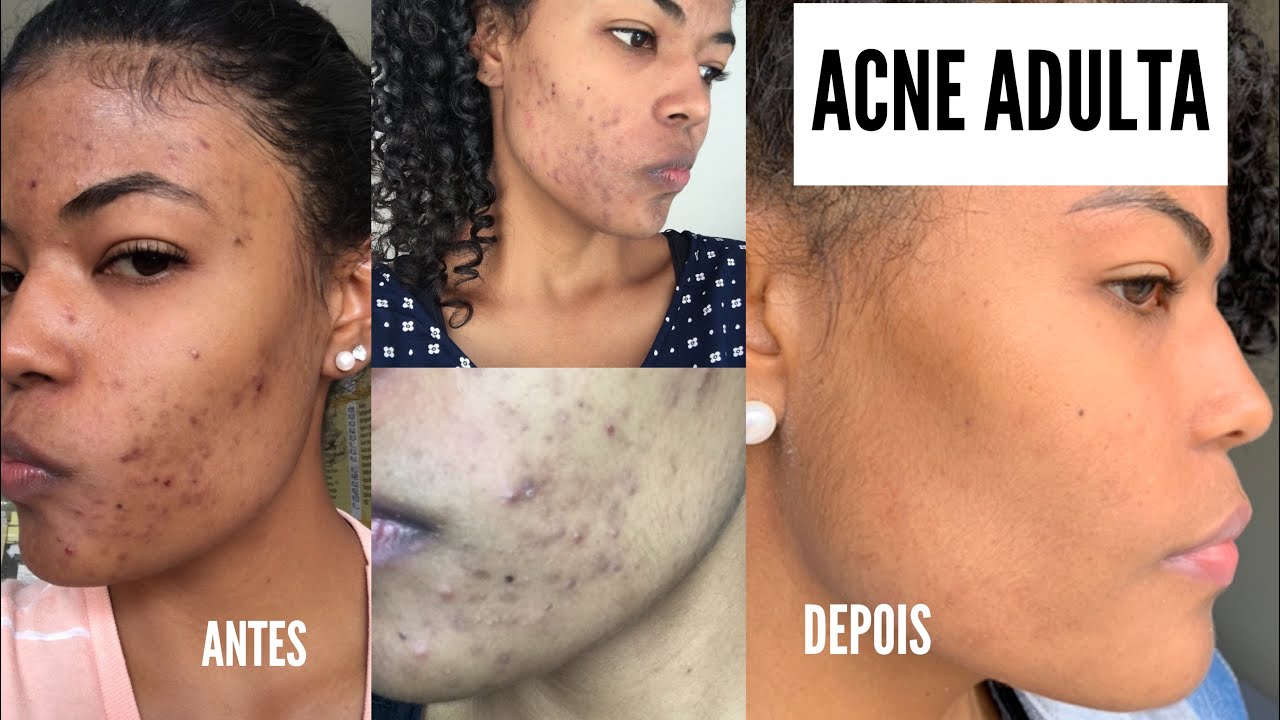 ACNE ADULTA | Minha experiência, tratamento, produtos e manchas! Antes e Depois com fotos.