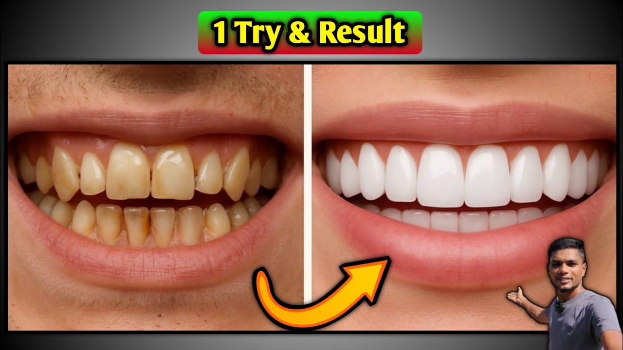 White Teeth in one Trick 😬 एक ही बार में दांत चमकाए ✨✨✨ Healthy Trip 