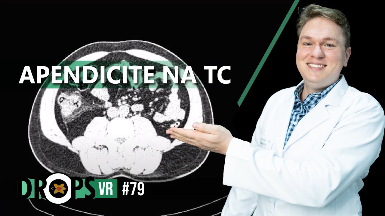 APENDICITE NA TC  PASSO A PASSO