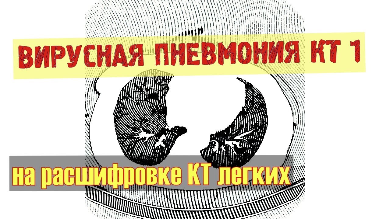 Картина двухсторонней ВИРУСНОЙ ПНЕВМОНИИ КТ 1 на РАСШИФРОВКЕ результатов КТ легих со снимков DICOM