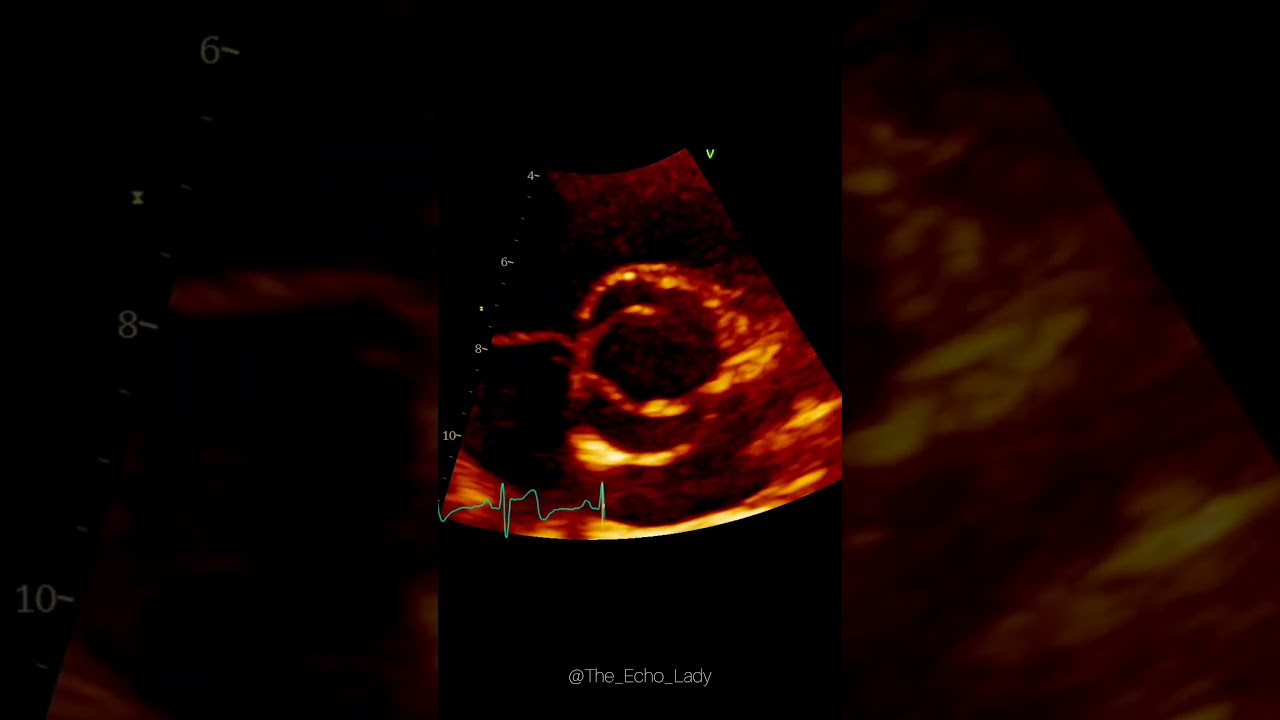 BAV! 🧡 #echocardiography #cardiology #echocardiogram #bicuspidvalve