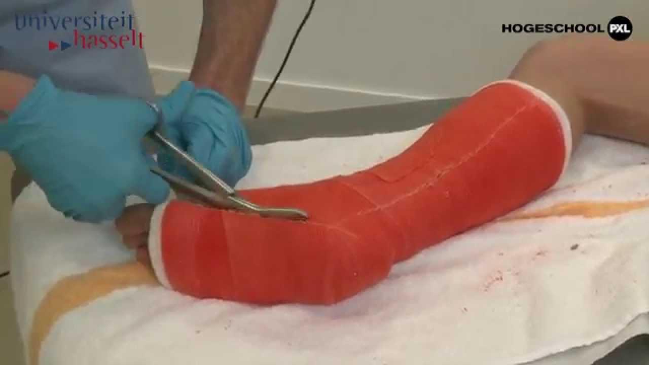 504 onderbeen circulaire synthetische gips