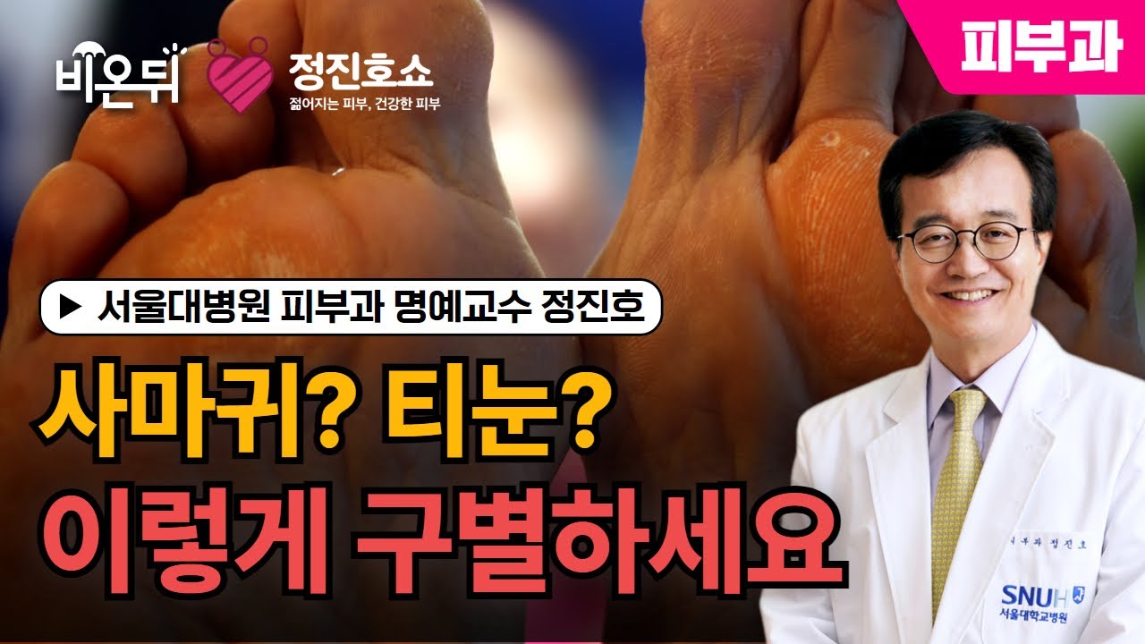[정진호쇼, 젊어지는 피부 건강한 피부]  사마귀인가? 티눈인가? 사마귀와 티눈을 구별하는 법 / 서울대병원 피부과 명예교수 정진호
