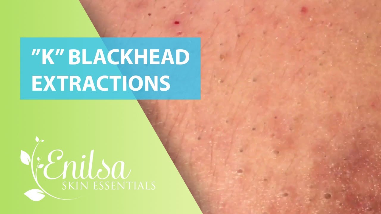 Blackheads Extractions &ldquo;K&rsquo;s&rdquo; 4th Treatment