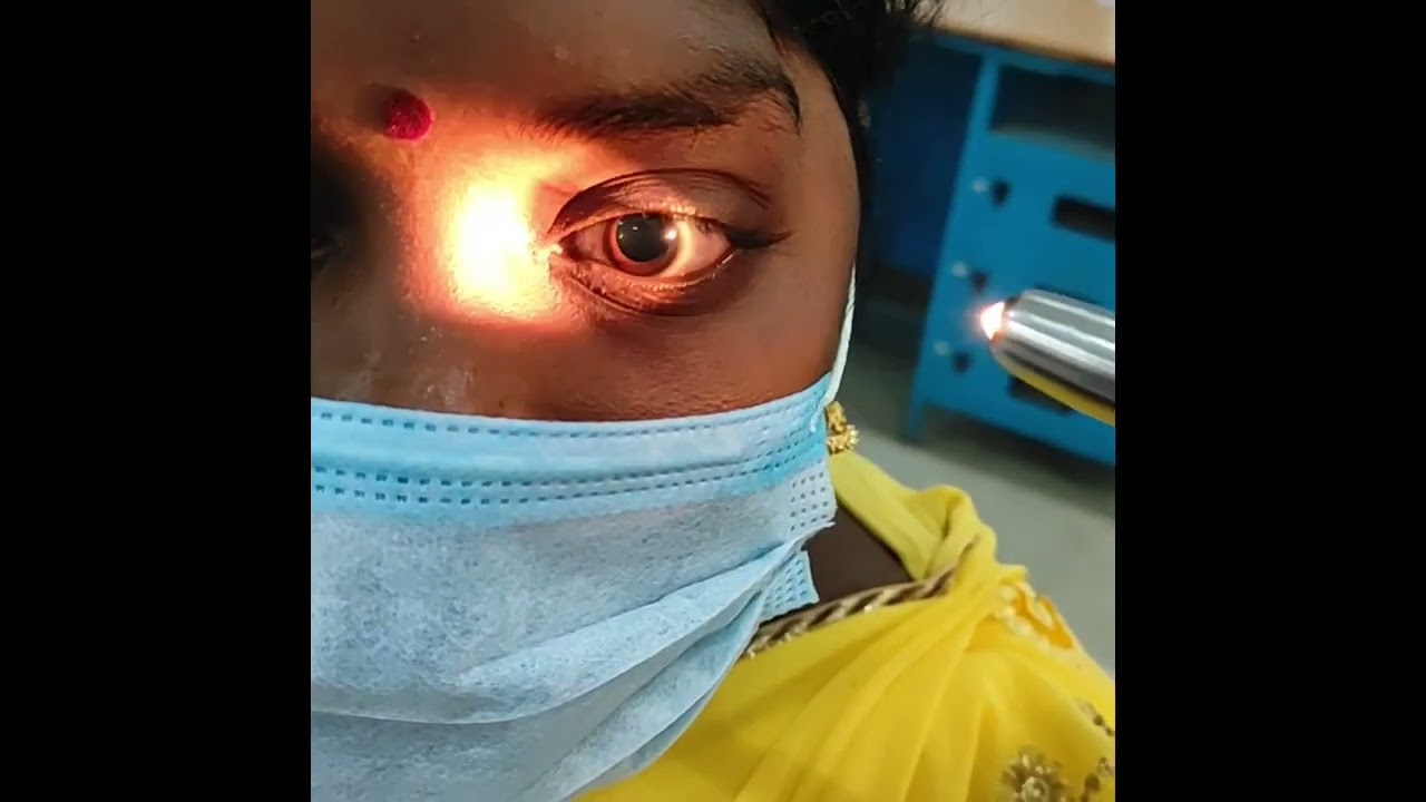 Bilateral dilated pupil not reacting to light due to optic nerve injury