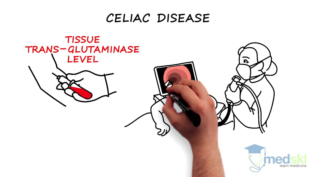 Gastroenterology - Chronic Diarrhea: By Sylvain Coderre M.D.