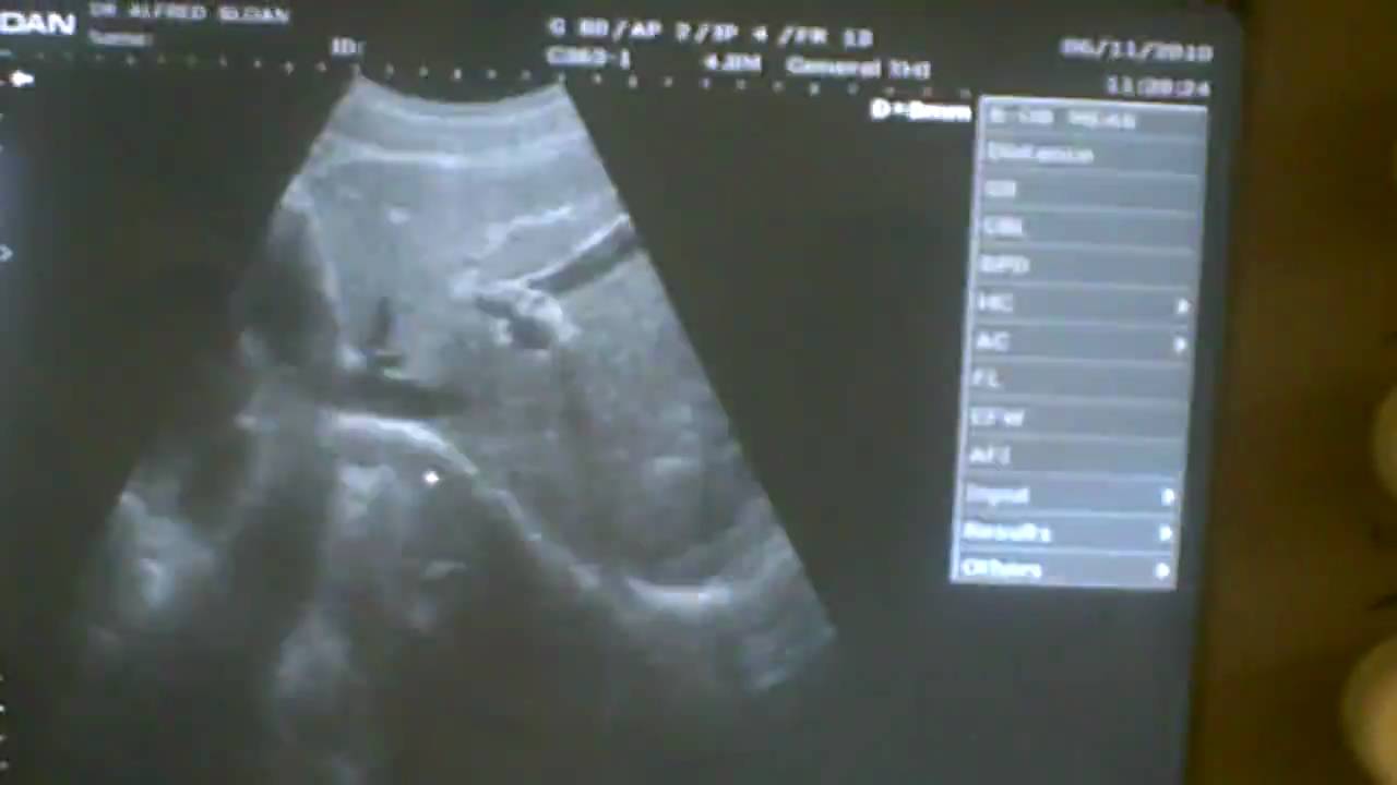 Edan DUS 6 (4of5).AVI (by WesternMedicalSolutions.com)
