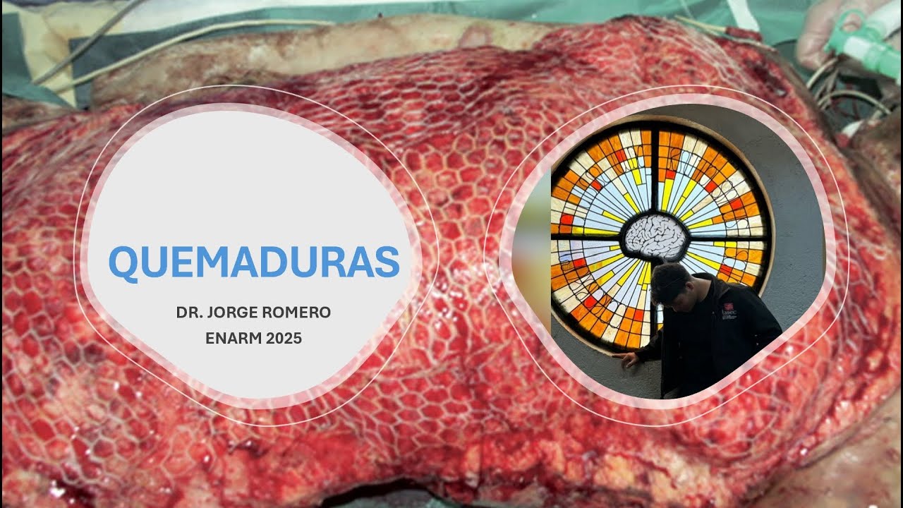 QUEMADURAS // ENARM 2025 // GPC