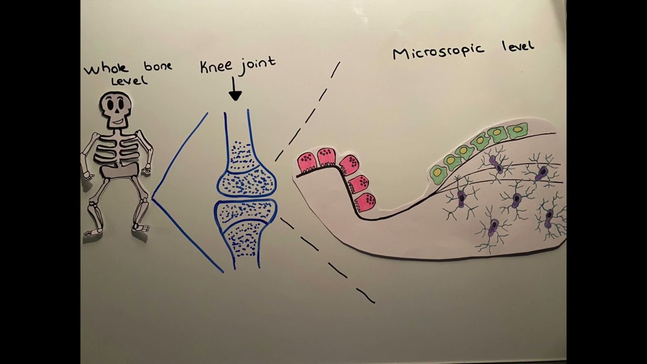 How does diabetes affect bone health?
