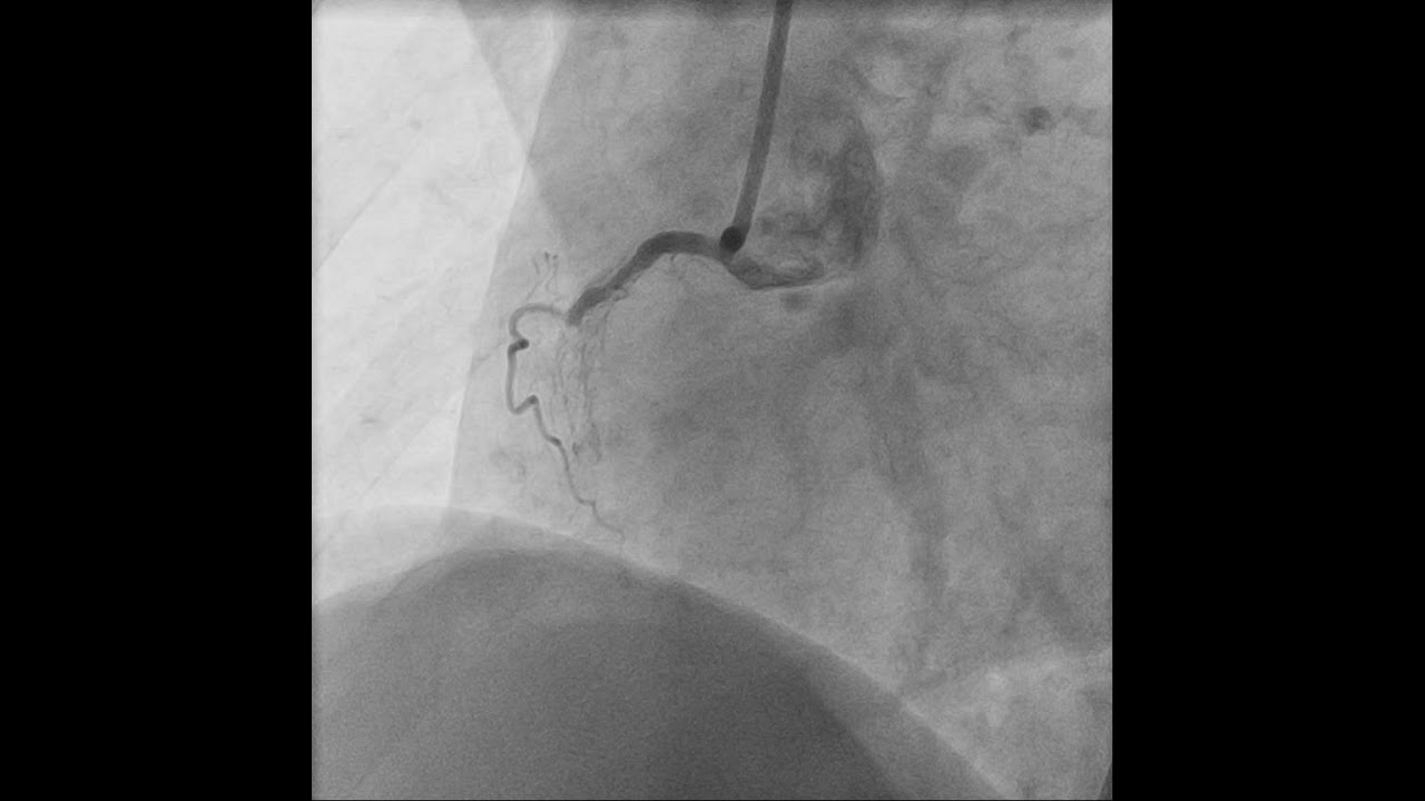 CTO intervention, second attempt is different