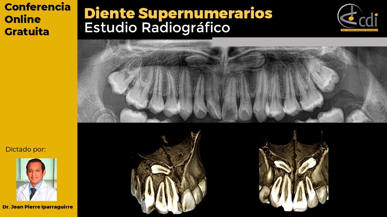 Dientes Supernumerarios Estudio Radiográfico
