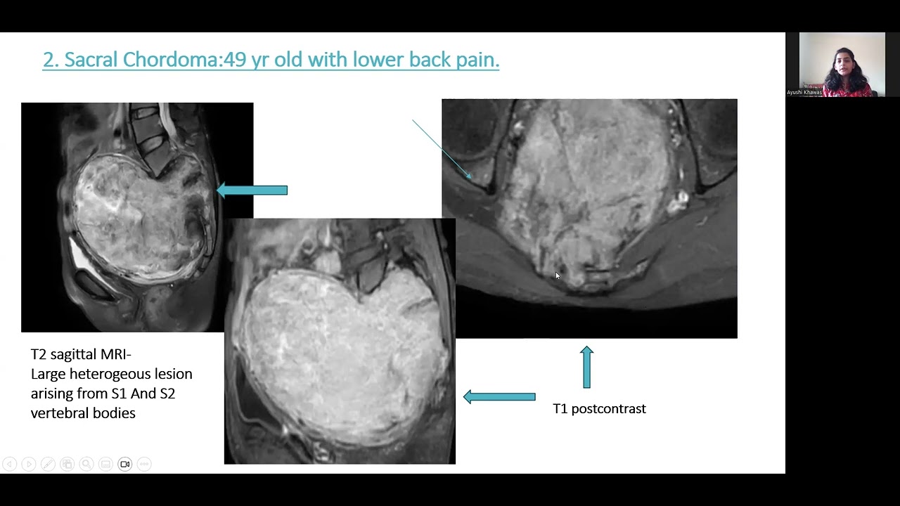Ayushi Khawas | MRI in evaluation of pelvic pathologies #mriteachingcourse