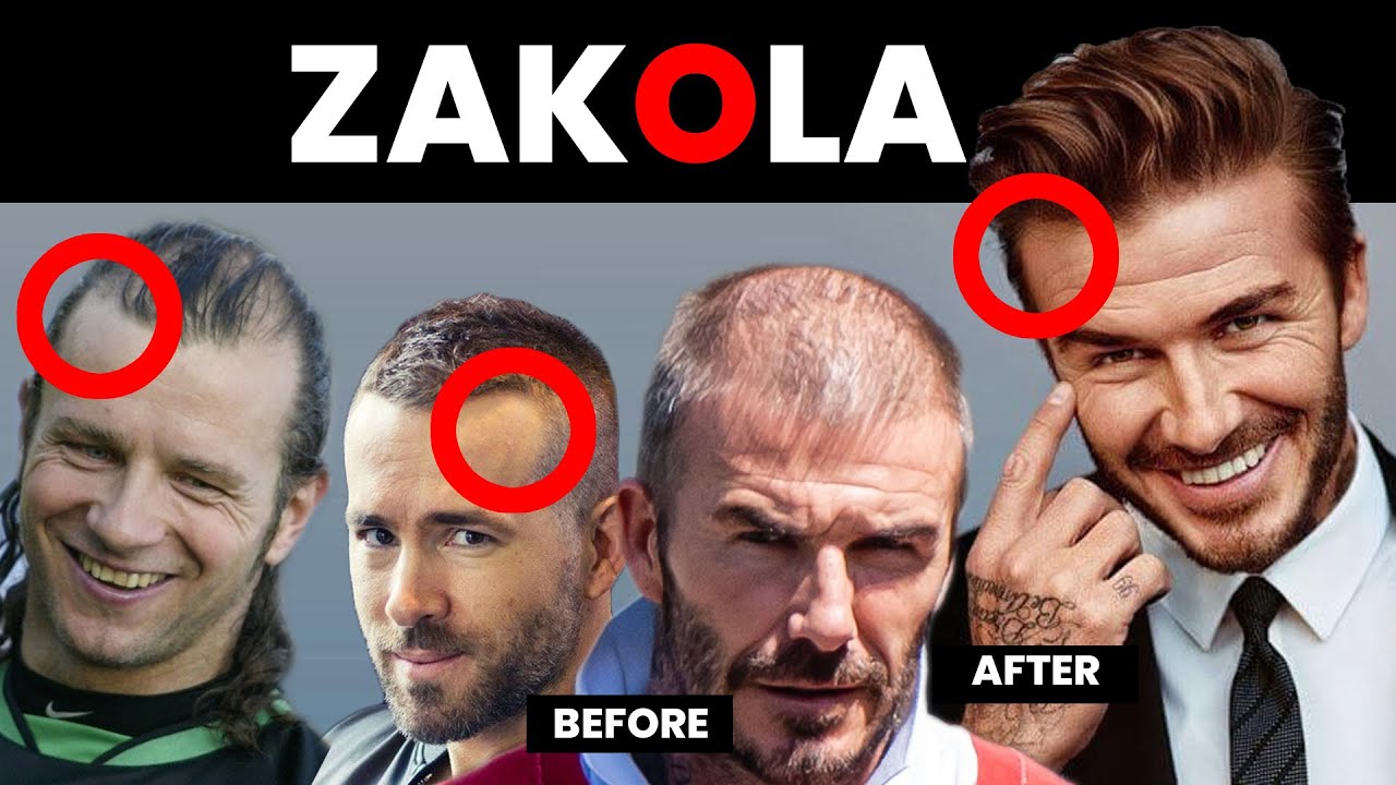 ZAKOLA – Fryzury Męskie i Sposoby Na ZAKOLA. STOP na Wypadanie Włosów!