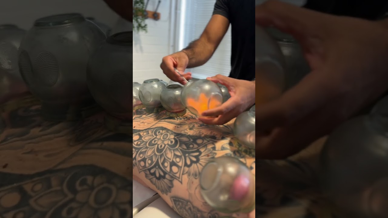 This tattoo shows how cupping works on our skin 🤯 #chiropractor #cupping #physiotherapy