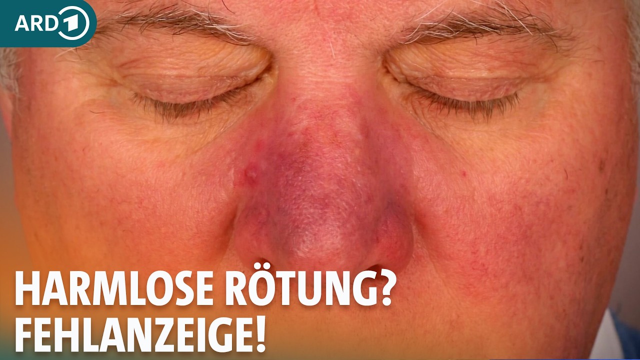Rosazea: Symptome, Ursachen und Behandlung I ARD Gesund