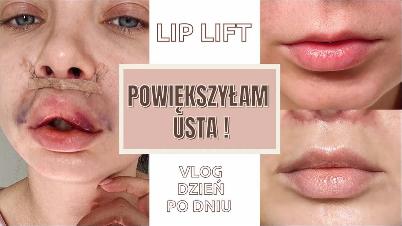 POWIĘKSZYŁAM USTA CHIRURGICZNIE 😱  ZA ILE, JAK I CZY BOLAŁO?