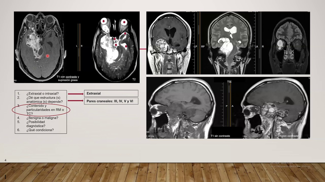 ALGUNOS TIPS PARA DIAGNÓSTICO DE TUMORES CEREBRALES
