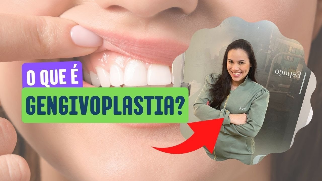 Gengivoplastia - A Famosa cirurgia para 