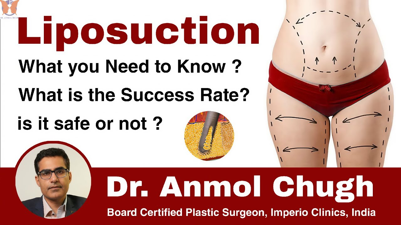 Liposuction -What you Need to Know | Is It Safe | What is the Success Rate?