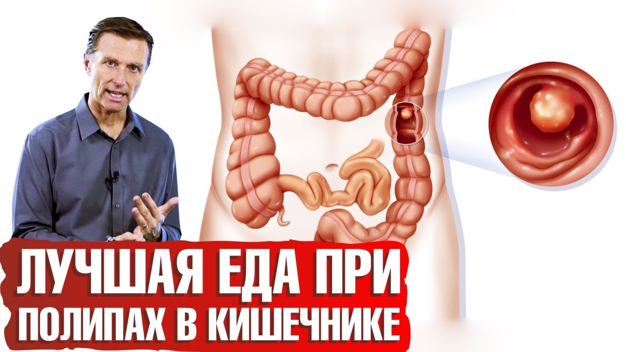 Профилактика полипов в толстой кишке: квашеная капуста!