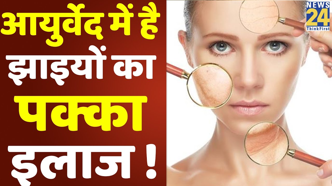 Sanjeevani: डॉक्टर प्रताप चौहान से जानिए झाइयों को दूर करने का आयुर्वेदिक इलाज