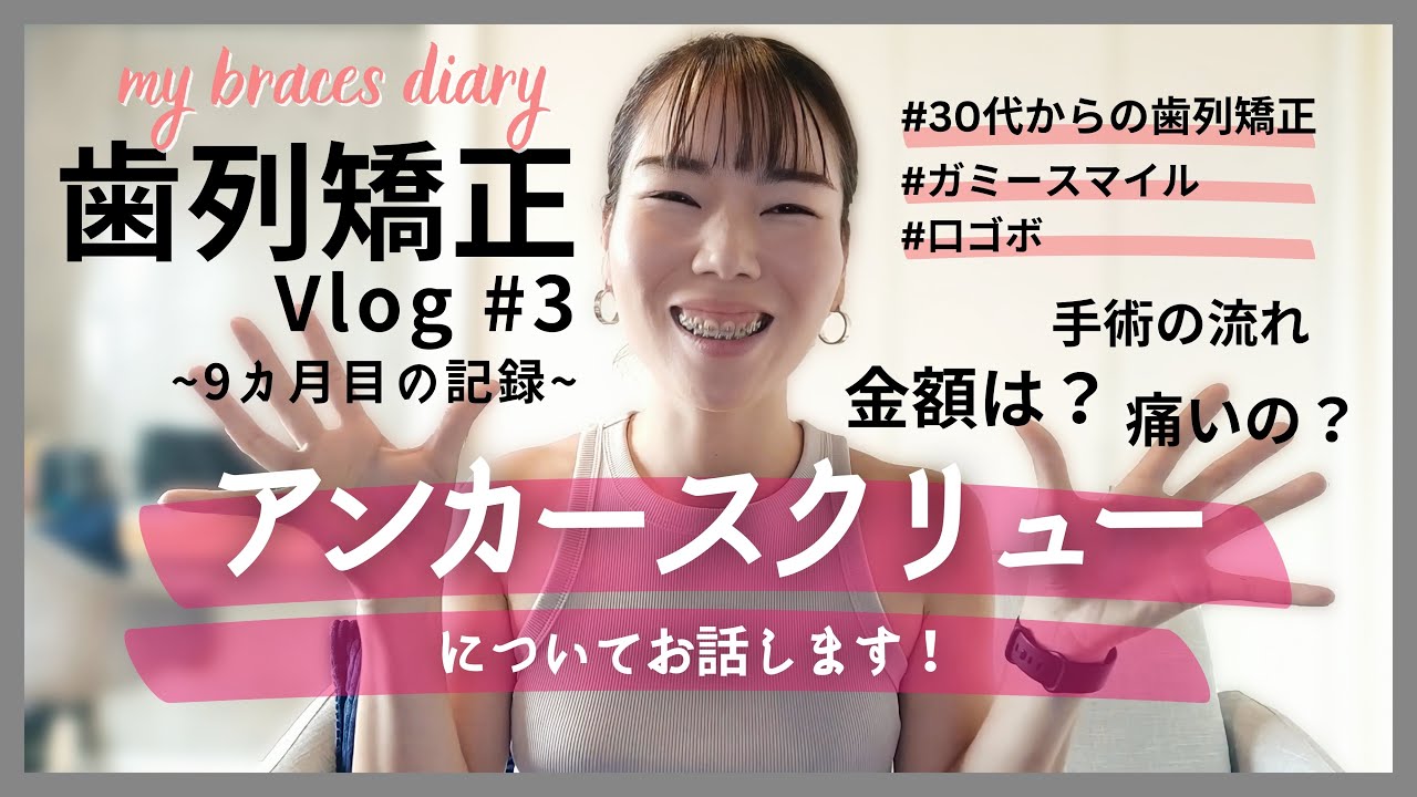 【歯列矯正】裏側アンカースクリューについてお話します。9ヵ月目の記録｜ガミースマイルはどれだけ改善されたのか？