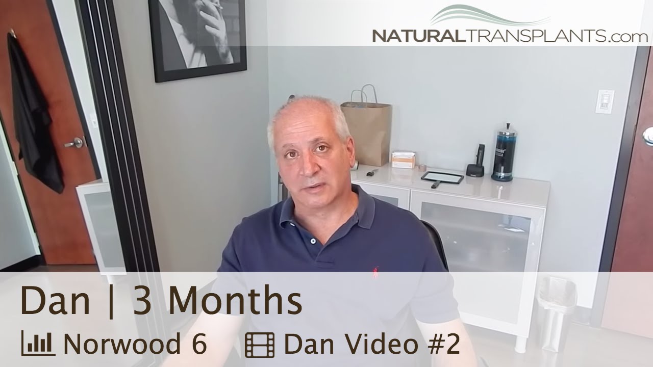 90 Day Hair Transplant Post-Op Follow-Up, FUT [Strip] & FUE Scar Truth - Orlando, Florida (Dan)