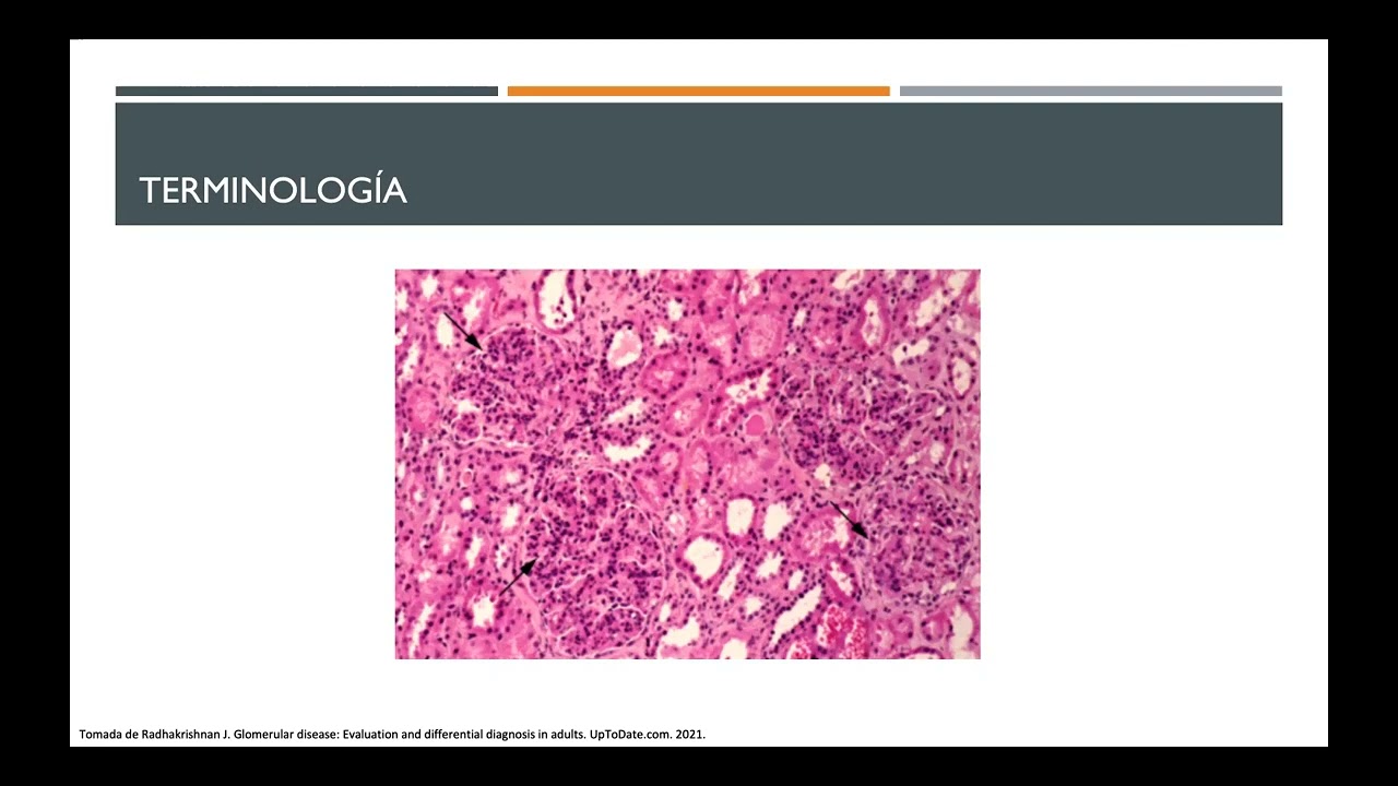 Abordaje del paciente con enf Glomerular
