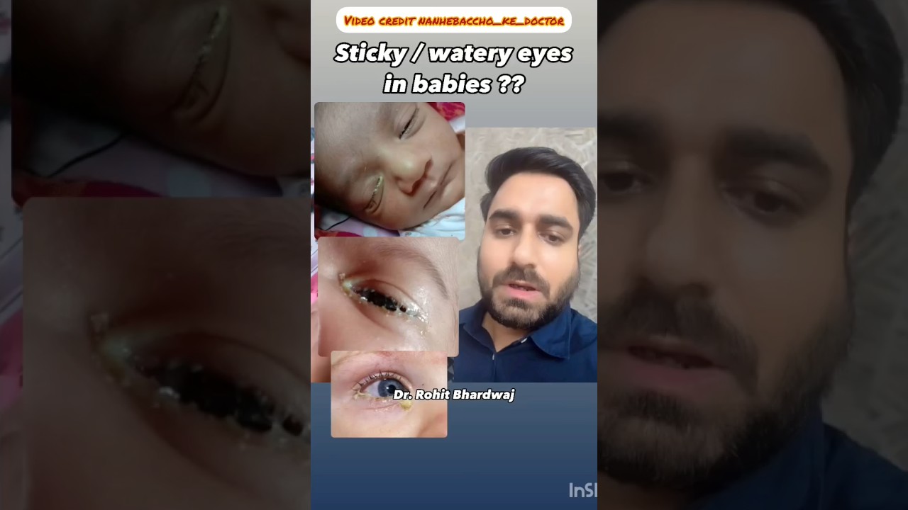 Watery / Sticky Eyes In Babies ..#viral #trending #parenting #wateryeyes #newborn #yt #ytshorts