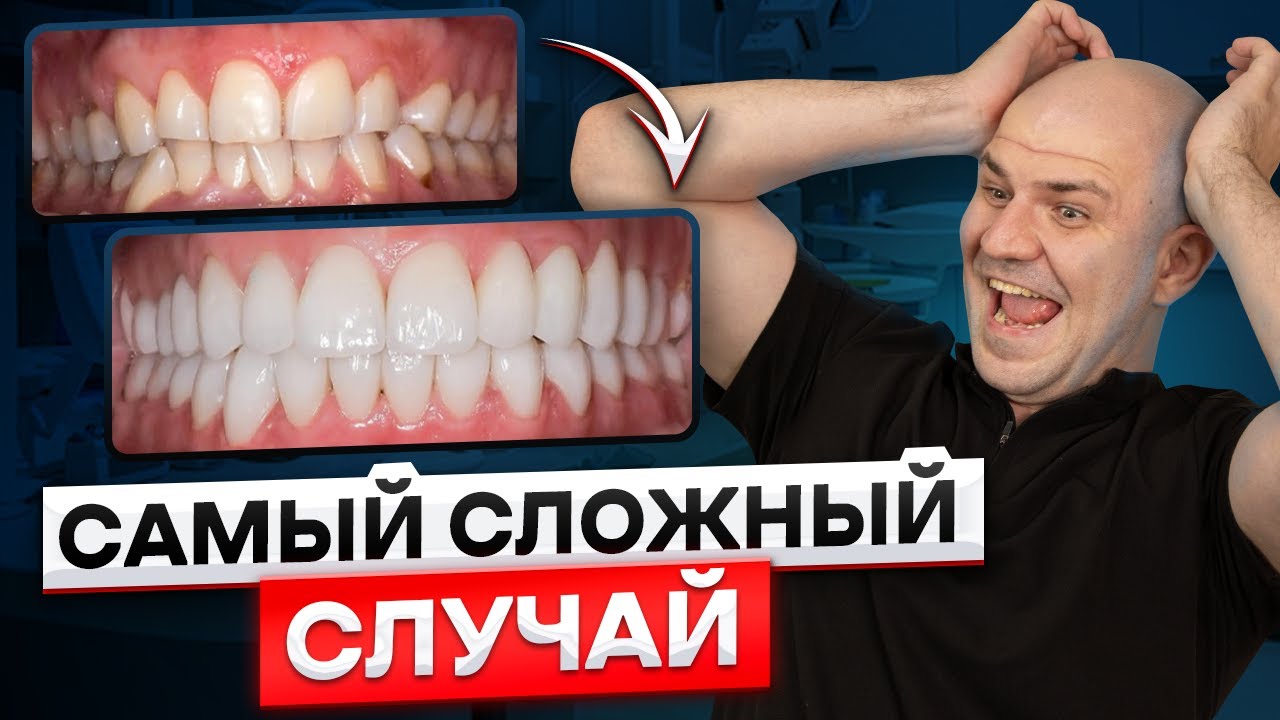 Как 1 удалённый зуб может ИСПОРТИТЬ всё?! Вернули уверенность в себе