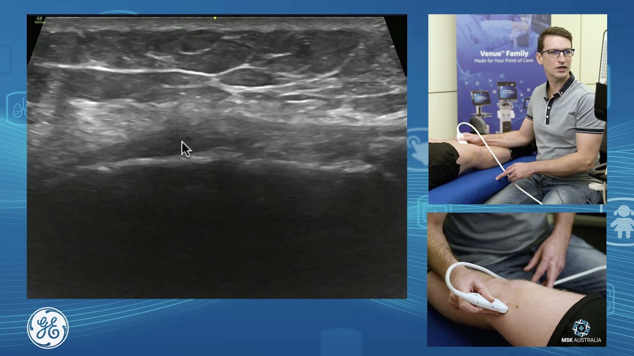 Sonographic assessment of the medial knee for POCUS clinicians