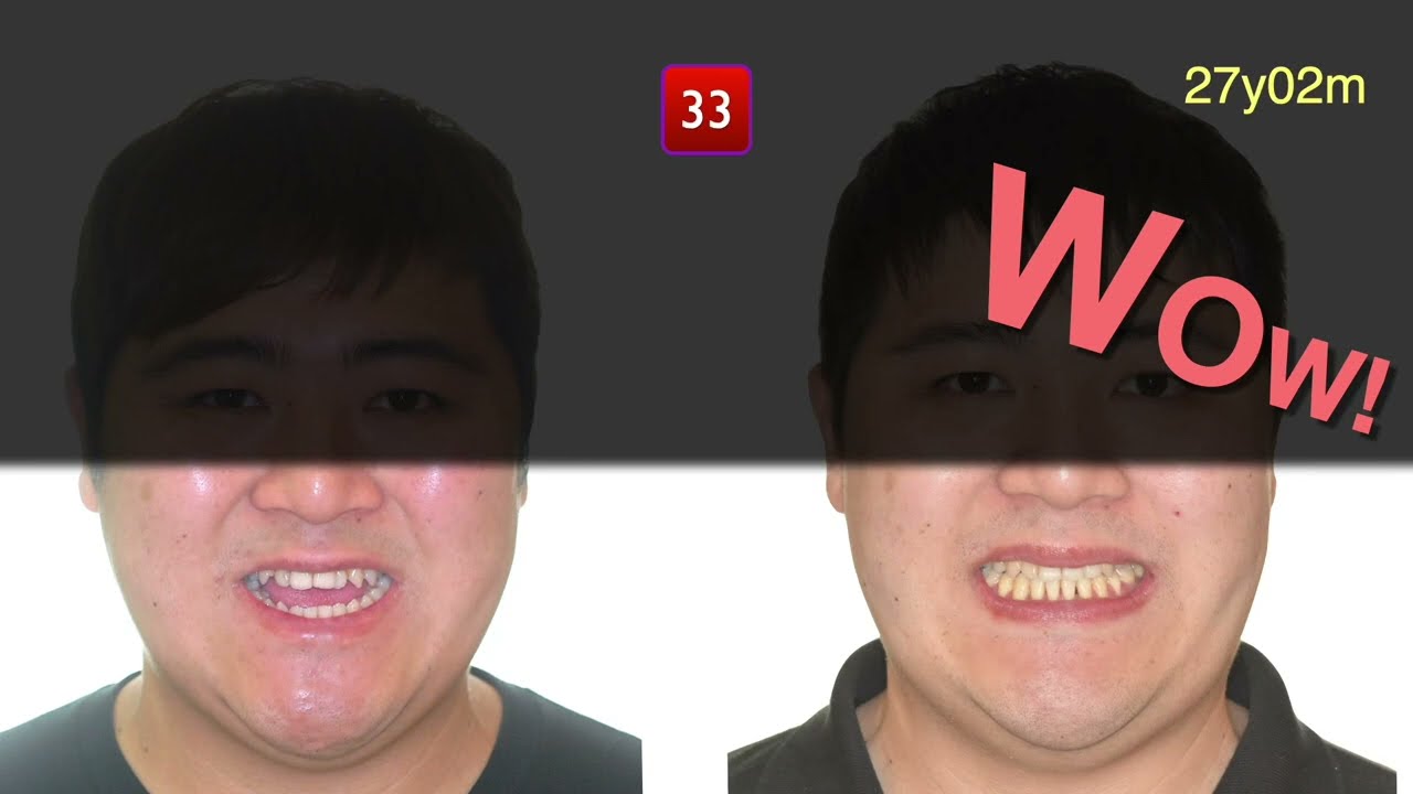 Solving anterior Openbite with Damon｜【Chris Chang Ortho】CC701