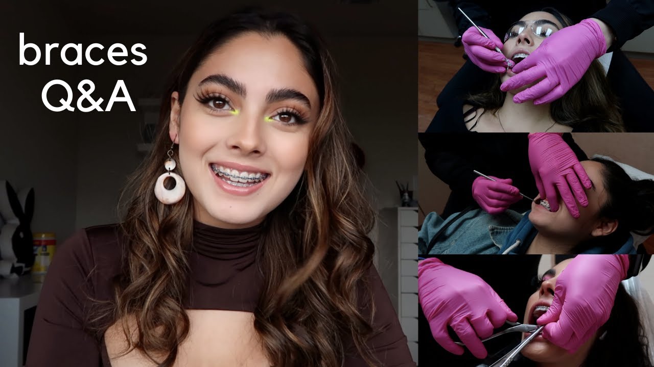 BRACES Q&A (cost, pain, experience, extractions + everything else you need to know)