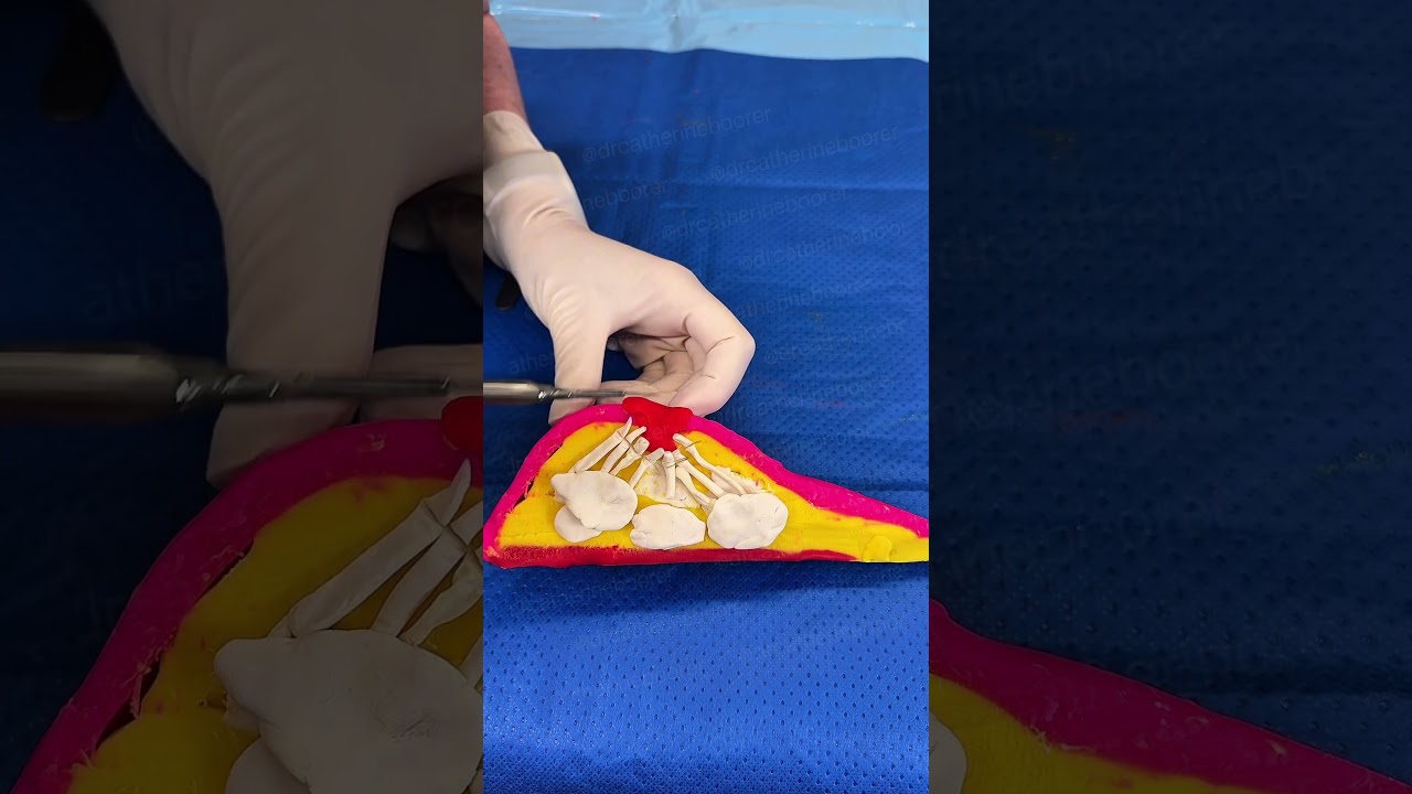 Inverted Nipple Surgery &ndash; Play-Doh Demo