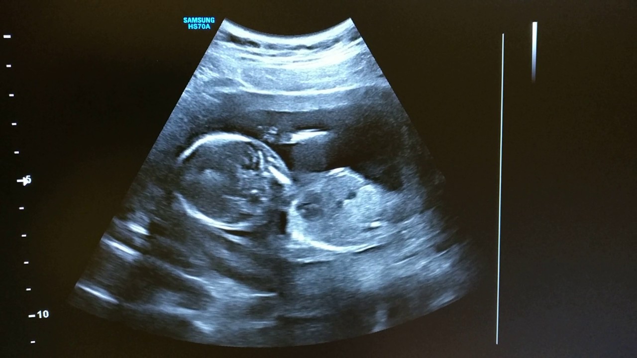 16 Weeks Pregnant / Ultraschall 16. SSW